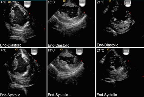 2d echo normal result sample|What is 2d Echo test and its Uses, Test Results, and Normal .